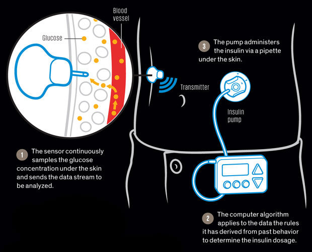 Robo-pancreas